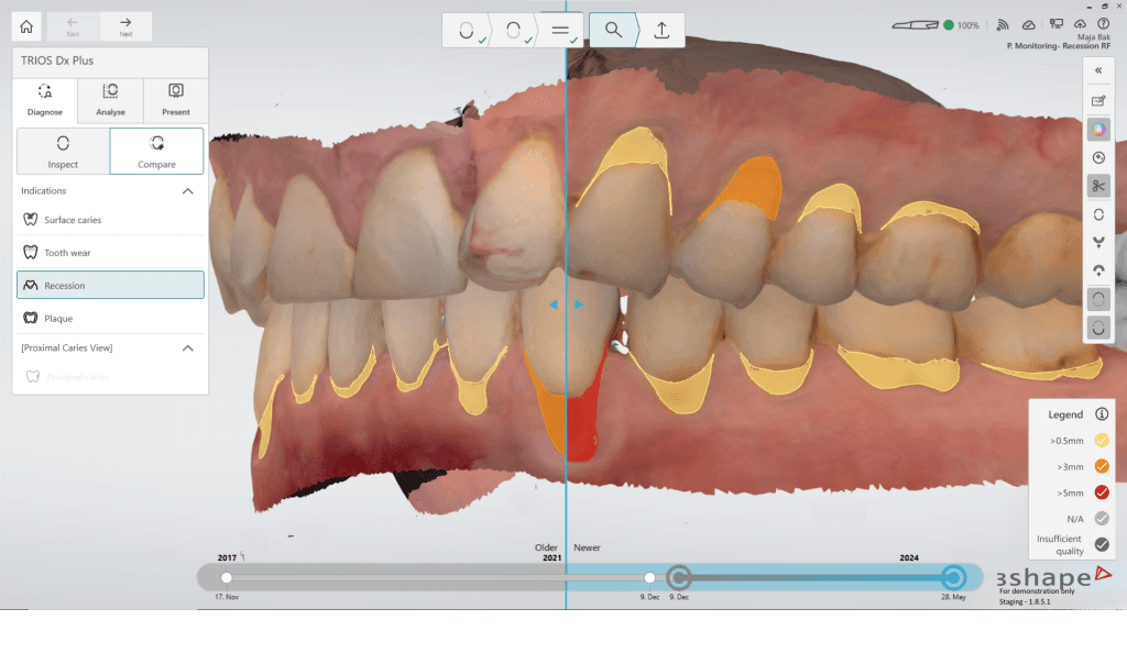 intraoral escaner 3d