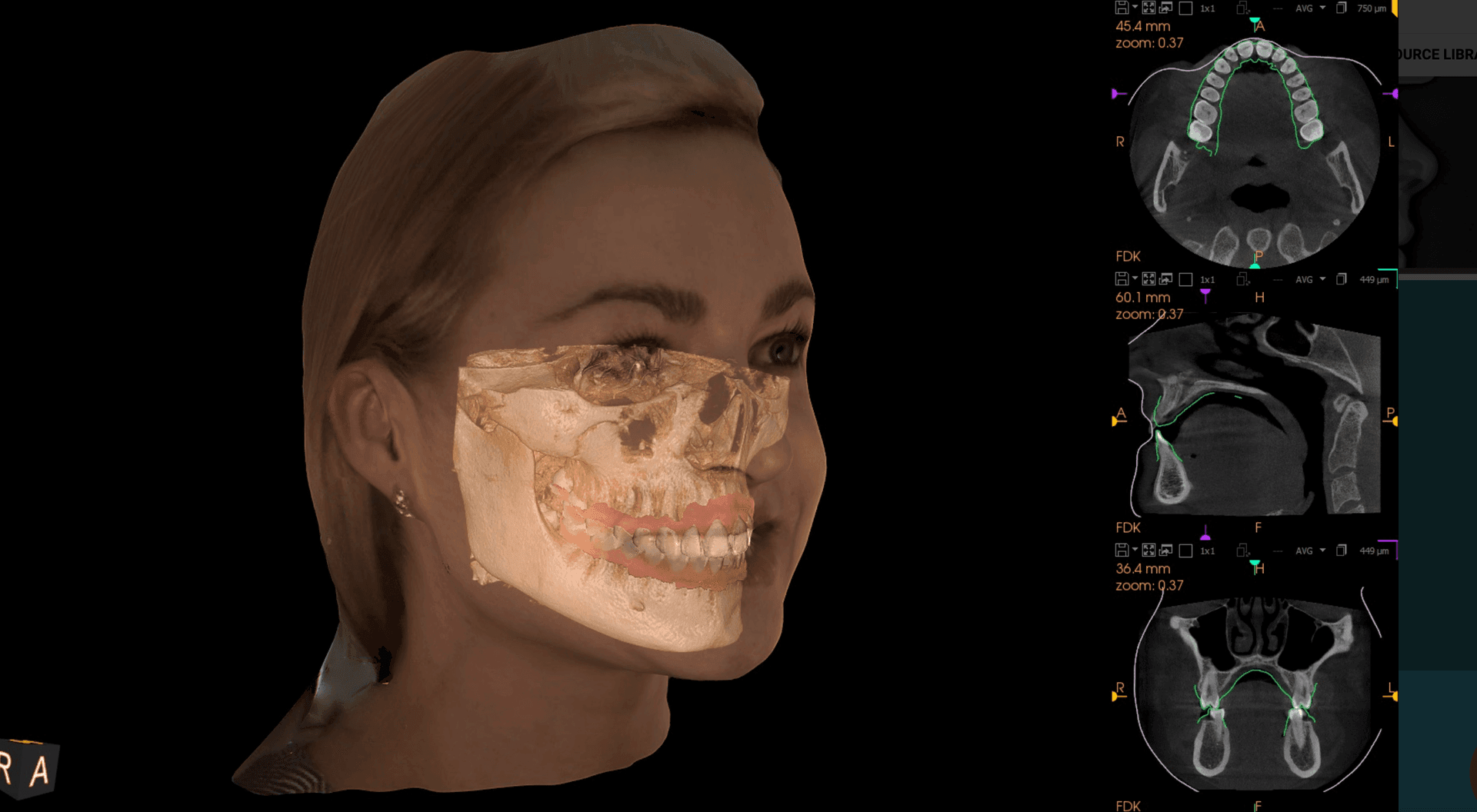 dental implant digital planning